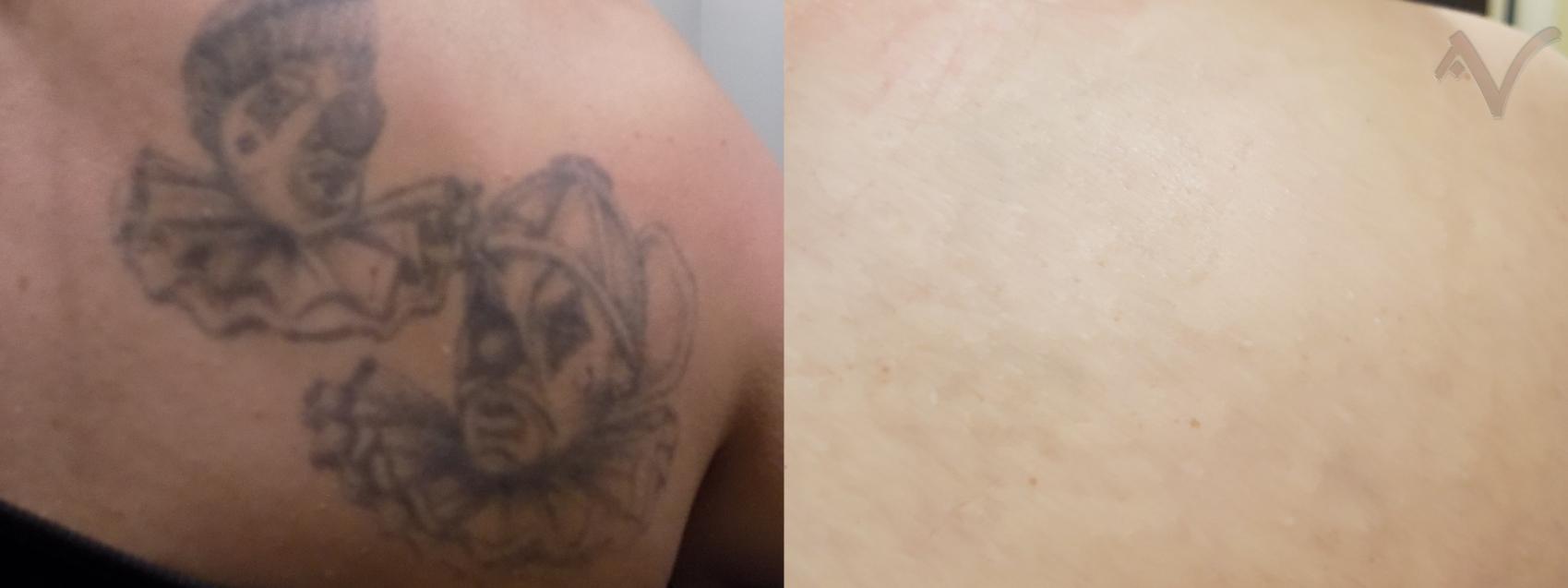 Before & After Laser Tattoo Removal Case 410 Back View in Los Angeles, CA