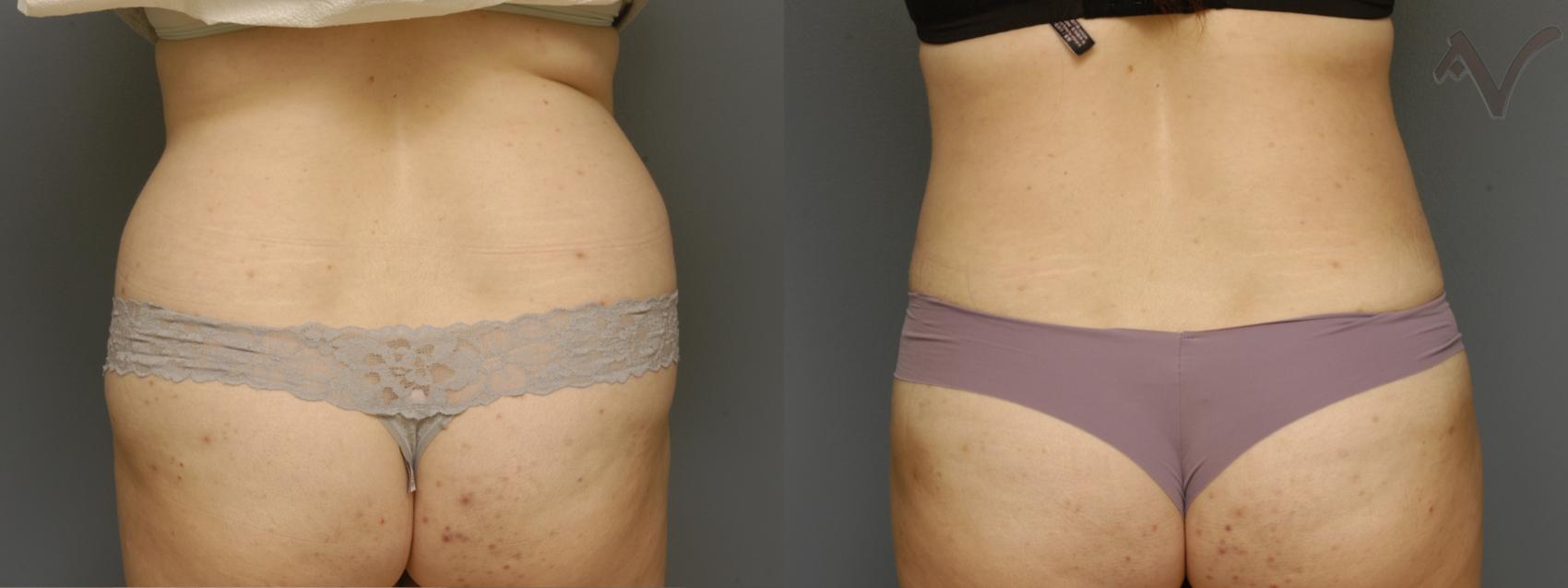Before & After Liposuction Case 353 Back View in Burbank, CA