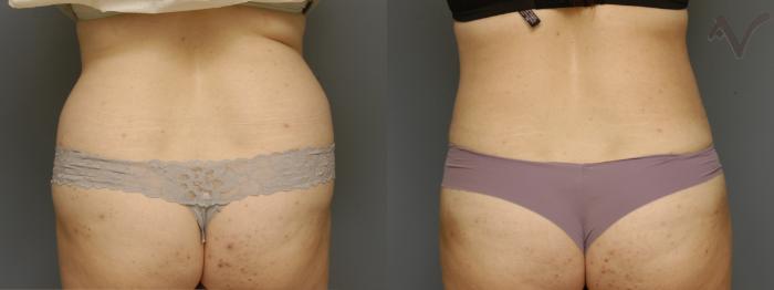 Before & After Liposuction Case 353 Back View in Los Angeles, CA