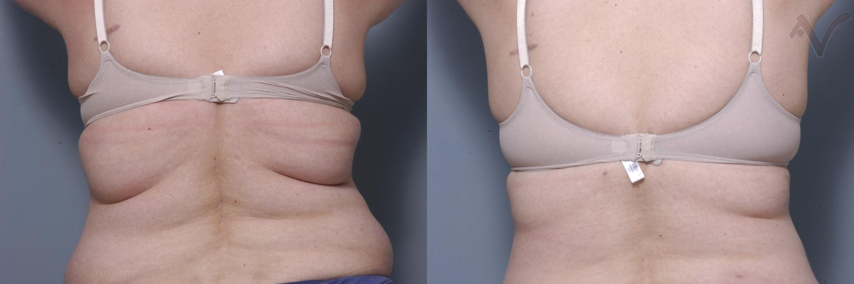 Before & After Liposuction Case 40 Back View in Burbank, CA