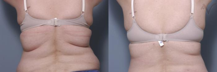 Before & After Liposuction Case 40 Back View in Los Angeles, CA