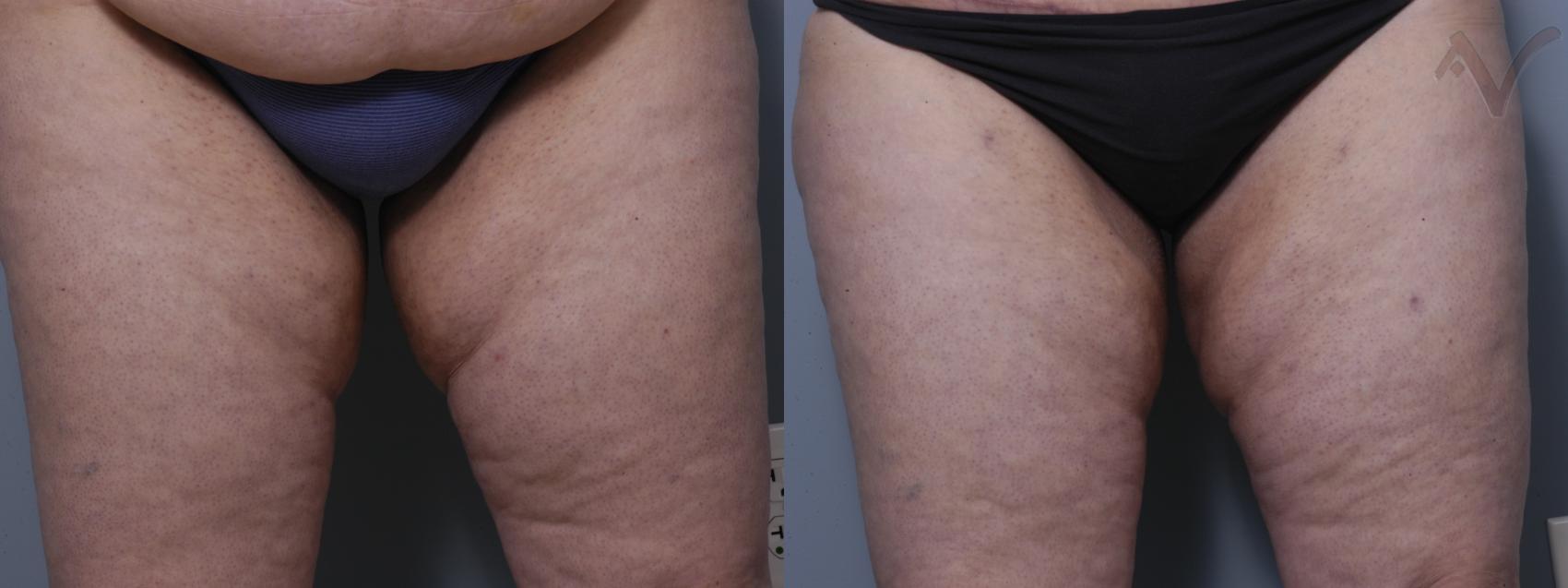 Before & After Liposuction Case 40 Front View of Thighs View in Burbank, CA