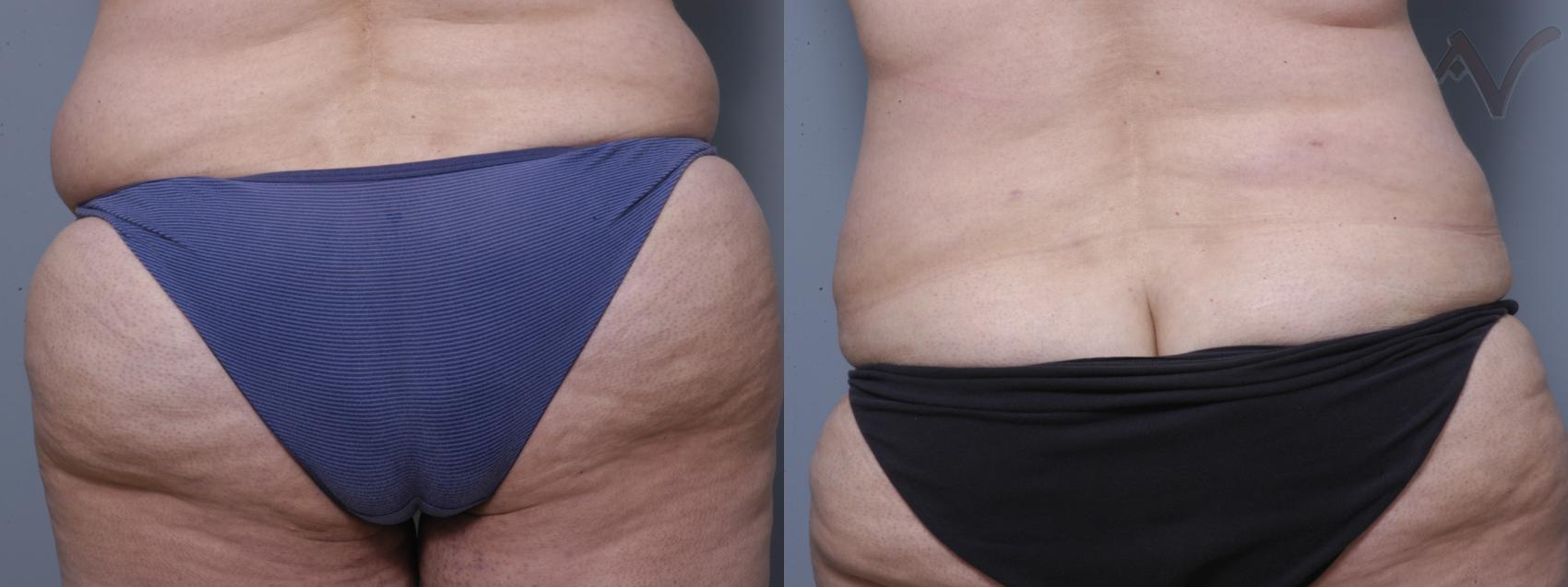 Before & After Liposuction Case 40 Lower Back View in Burbank, CA