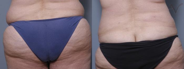Before & After Liposuction Case 40 Lower Back View in Los Angeles, CA