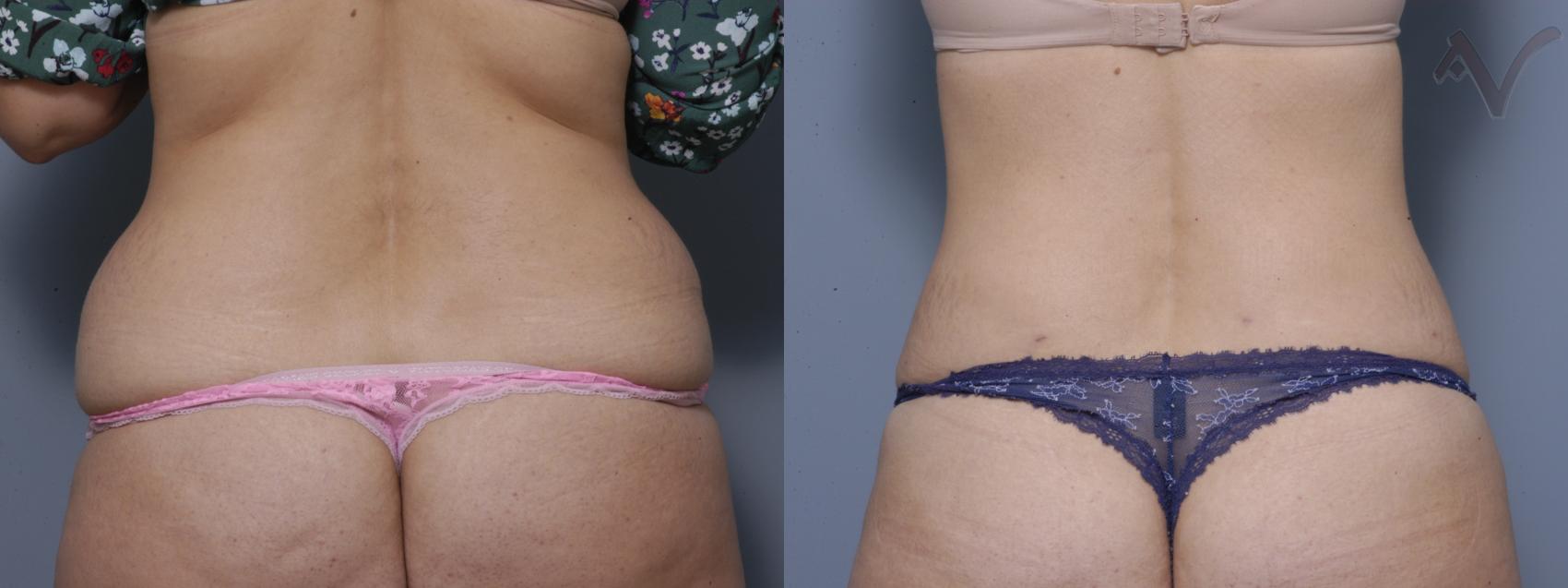 Before & After Liposuction Case 41 Back View in Burbank, CA