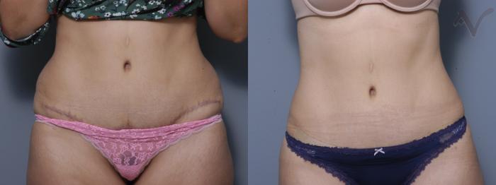 Before & After Liposuction Case 41 Front View in Los Angeles, CA