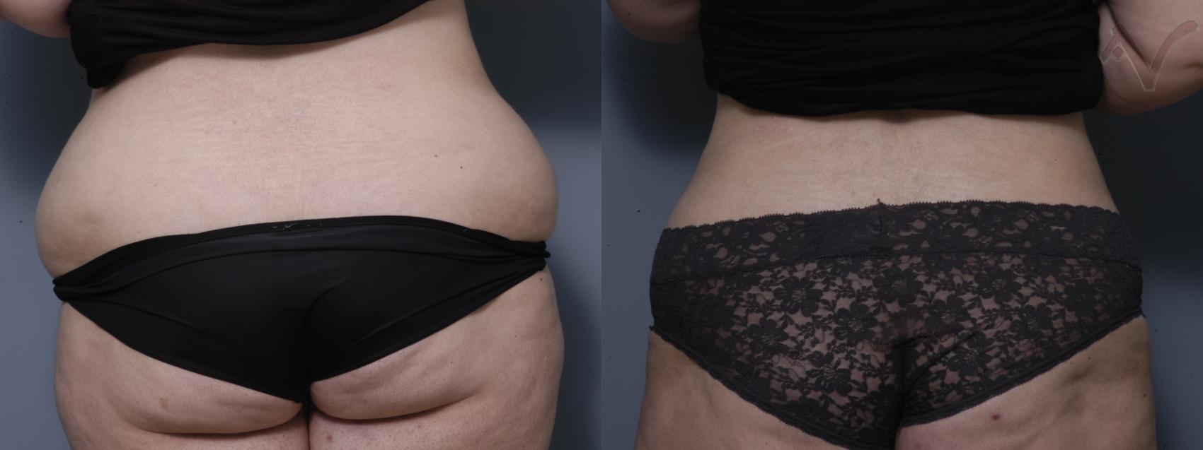 Before & After Liposuction Case 42 Back View in Burbank, CA