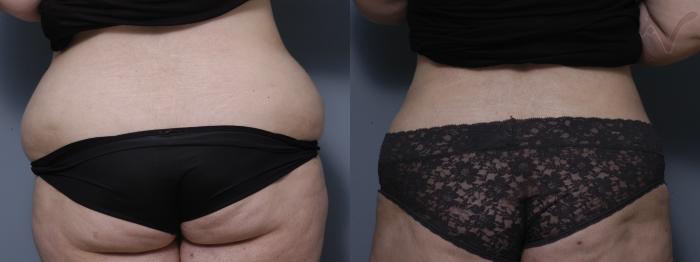 Before & After Liposuction Case 42 Back View in Los Angeles, CA