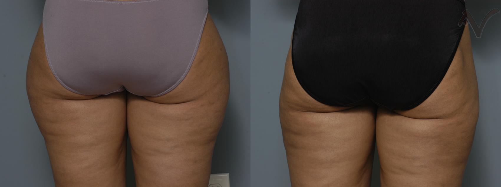 Before & After Liposuction Case 43 Back View of Thighs View in Burbank, CA
