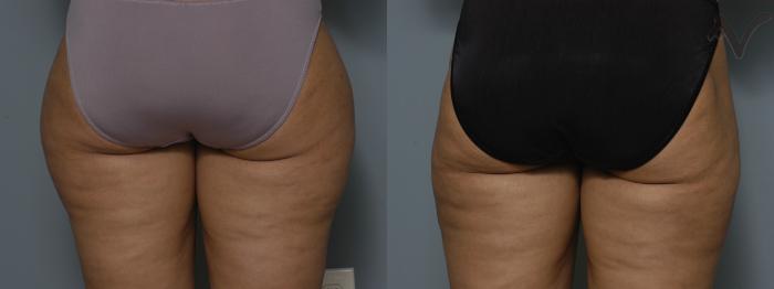 Before & After Liposuction Case 43 Back View of Thighs View in Los Angeles, CA