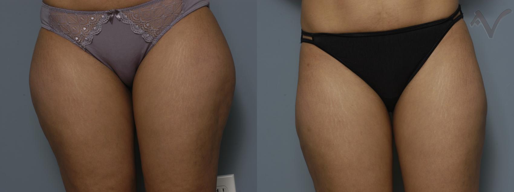 Before & After Liposuction Case 43 Front View of Thighs View in Los Angeles, CA