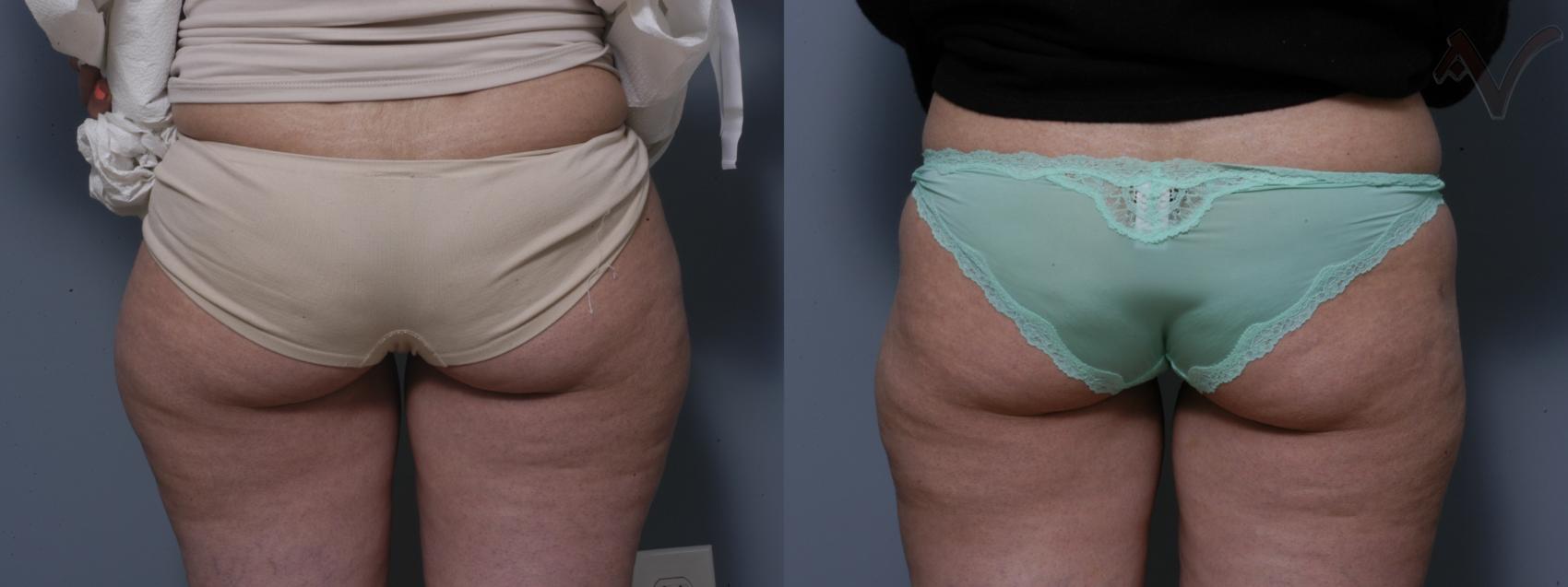Before & After Liposuction Case 44 Back View of Thighs View in Burbank, CA