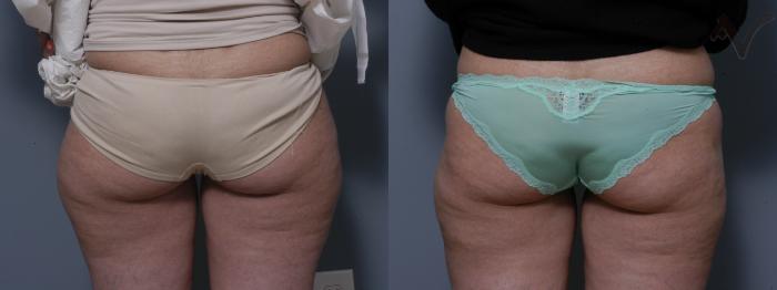 Before & After Liposuction Case 44 Back View of Thighs View in Los Angeles, CA