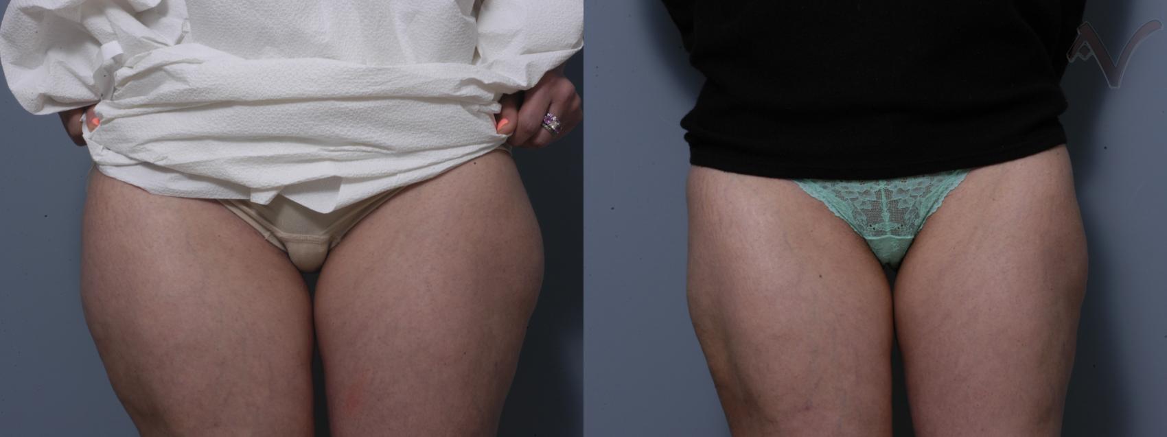 Before & After Liposuction Case 44 Front View of Thighs View in Burbank, CA