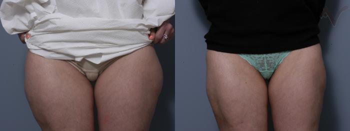 Before & After Liposuction Case 44 Front View of Thighs View in Los Angeles, CA