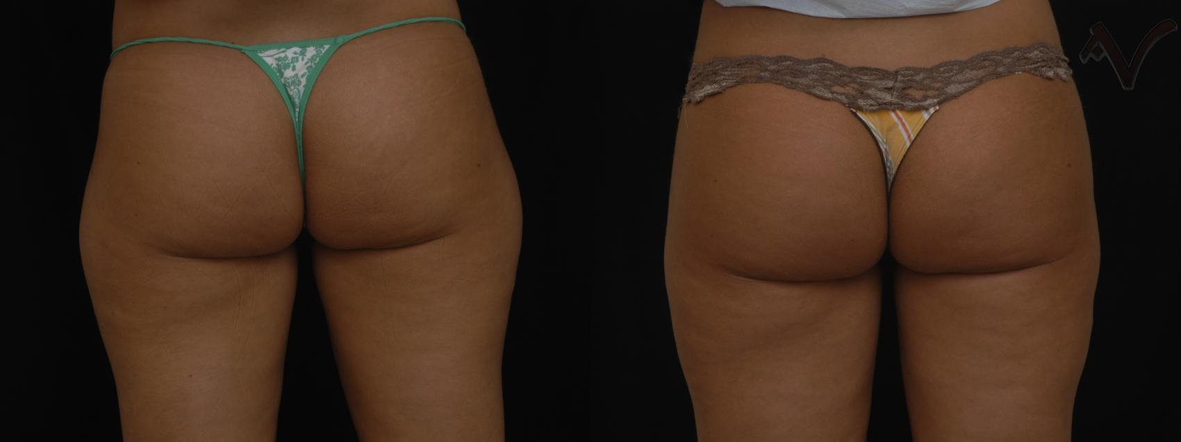 Before & After Liposuction Case 45 Back View of Thighs View in Burbank, CA