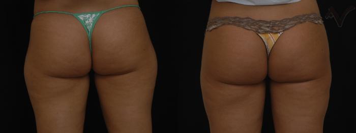 Before & After Liposuction Case 45 Back View of Thighs View in Los Angeles, CA