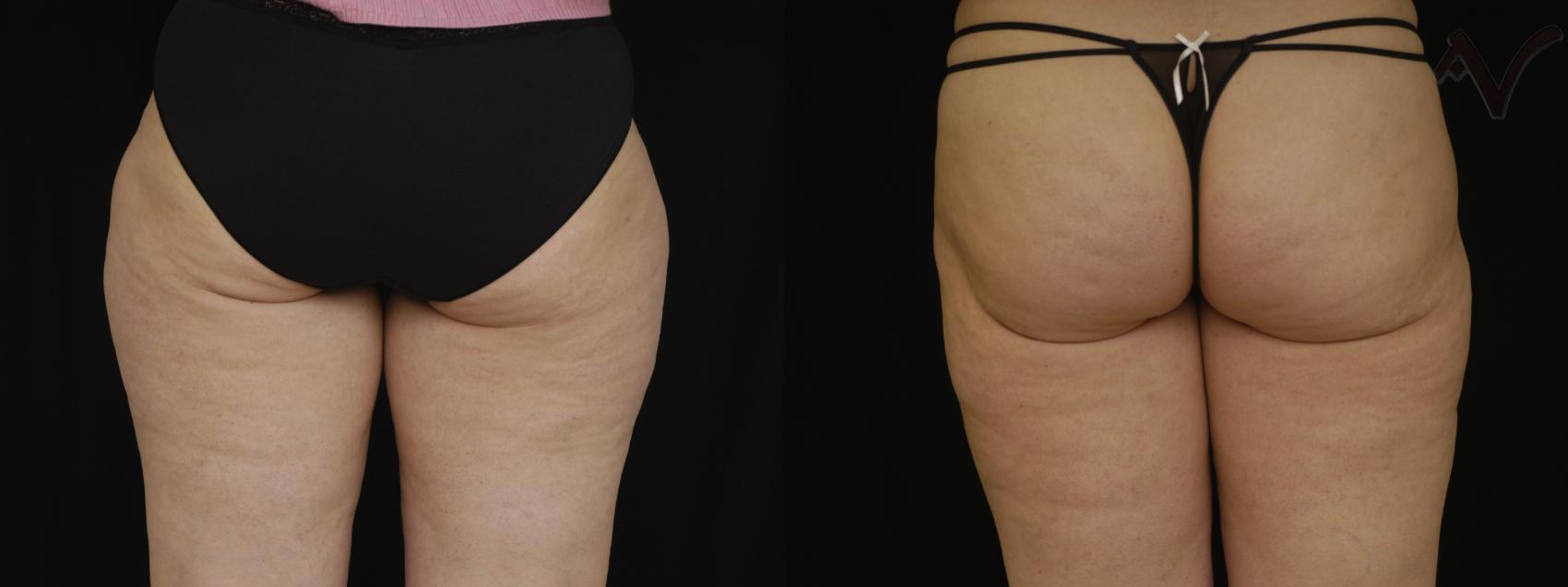 Before & After Liposuction Case 46 Back View of Thighs View in Burbank, CA