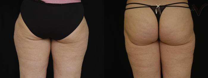 Before & After Liposuction Case 46 Back View of Thighs View in Los Angeles, CA