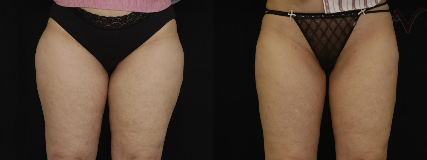 Before & After Liposuction Case 46 Front View of Thighs View in Burbank, CA