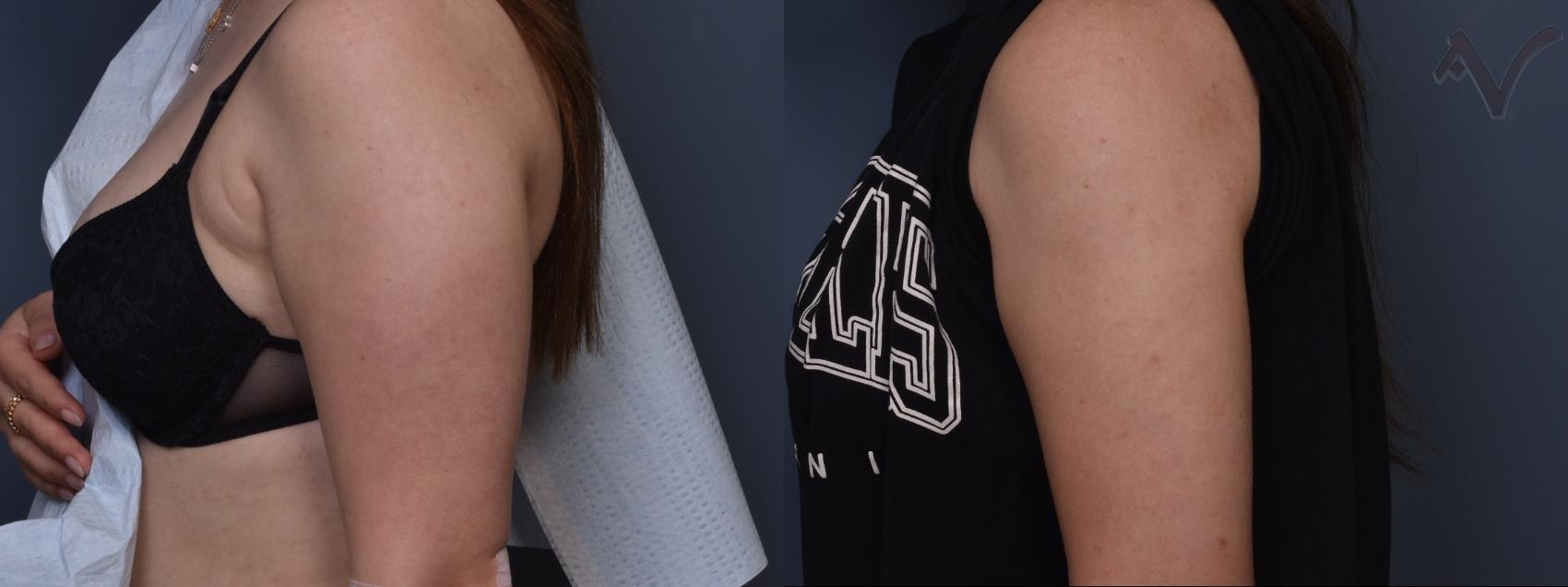 Before & After Liposuction Case 464 Left Side View in Los Angeles, CA
