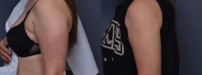 Before & After Liposuction Case 464 Left Side View in Los Angeles, CA