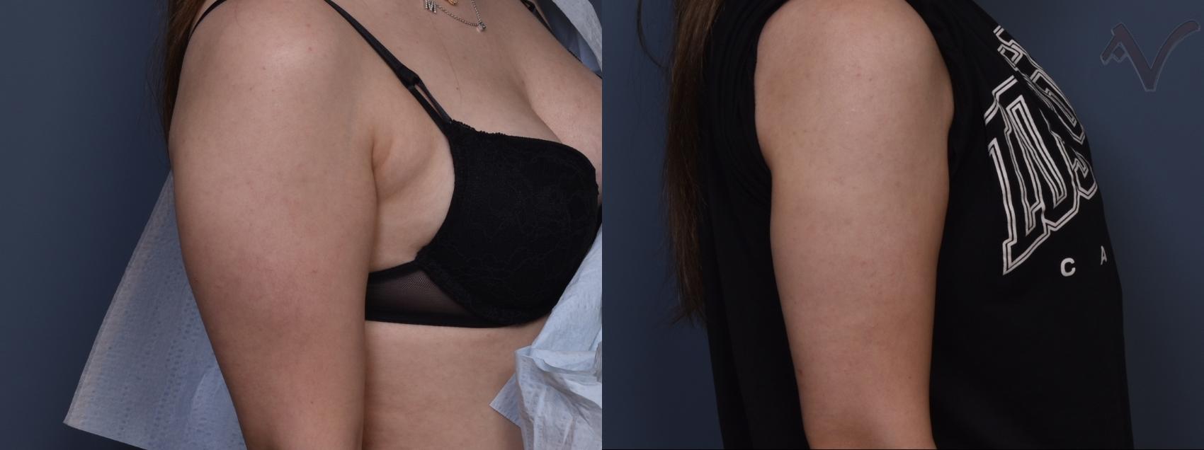 Before & After Liposuction Case 464 Right Side View in Los Angeles, CA