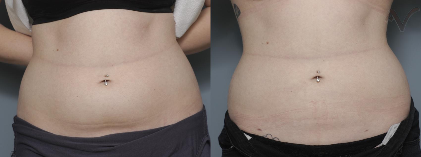 Before & After Liposuction Case 47 Front View in Burbank, CA