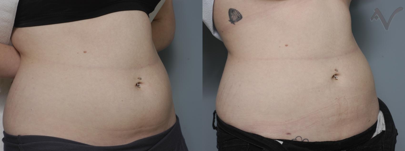 Before & After Liposuction Case 47 Right Oblique View in Burbank, CA