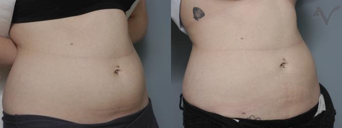 Before & After Liposuction Case 47 Right Oblique View in Los Angeles, CA
