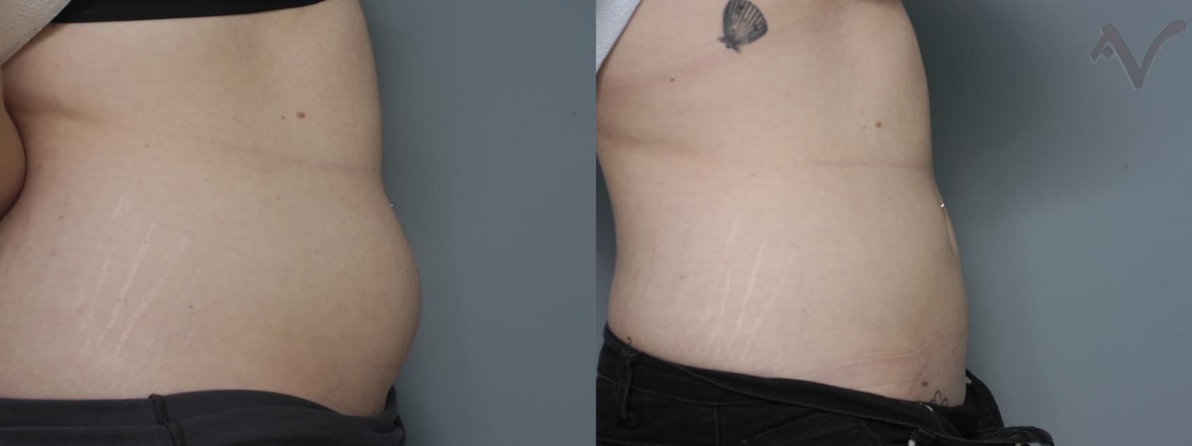 Before & After Liposuction Case 47 Right Side View in Burbank, CA