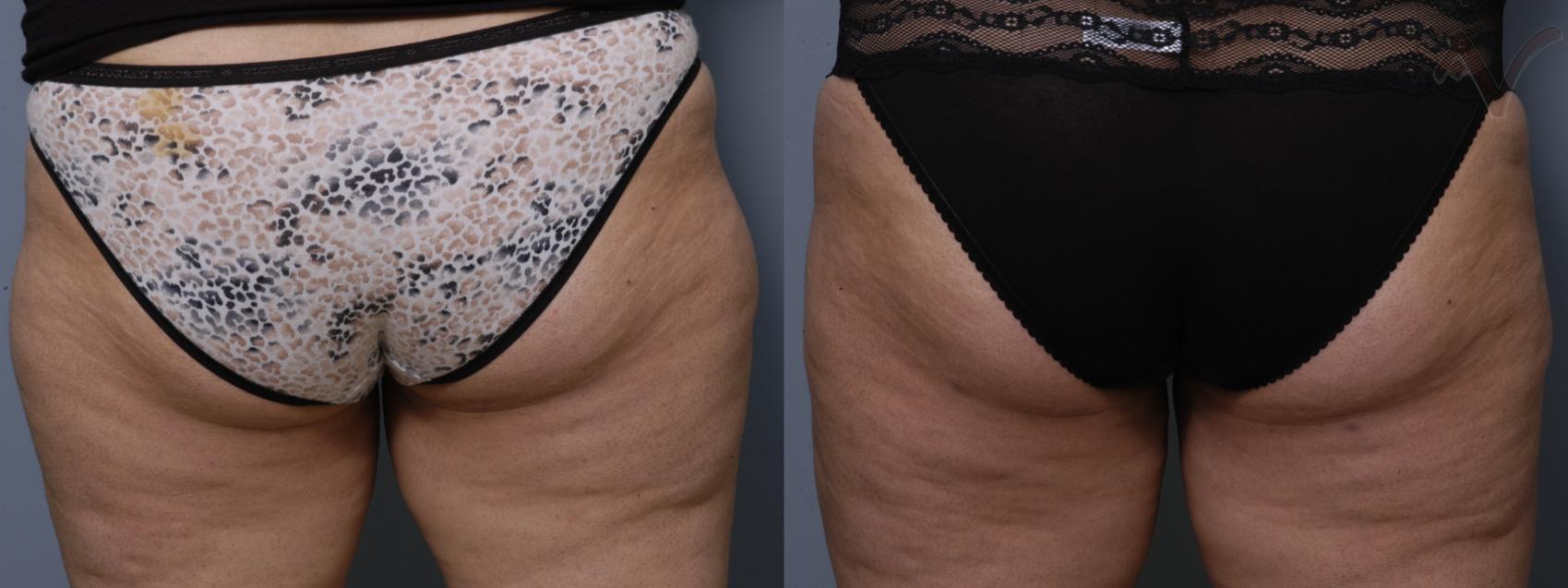 Before & After Liposuction Case 48 Back View of Thighs View in Burbank, CA