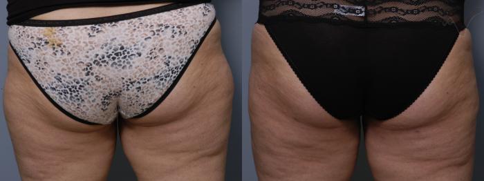 Before & After Liposuction Case 48 Back View of Thighs View in Los Angeles, CA