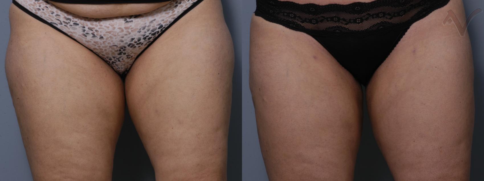 Before & After Liposuction Case 48 Front View of Thighs View in Burbank, CA
