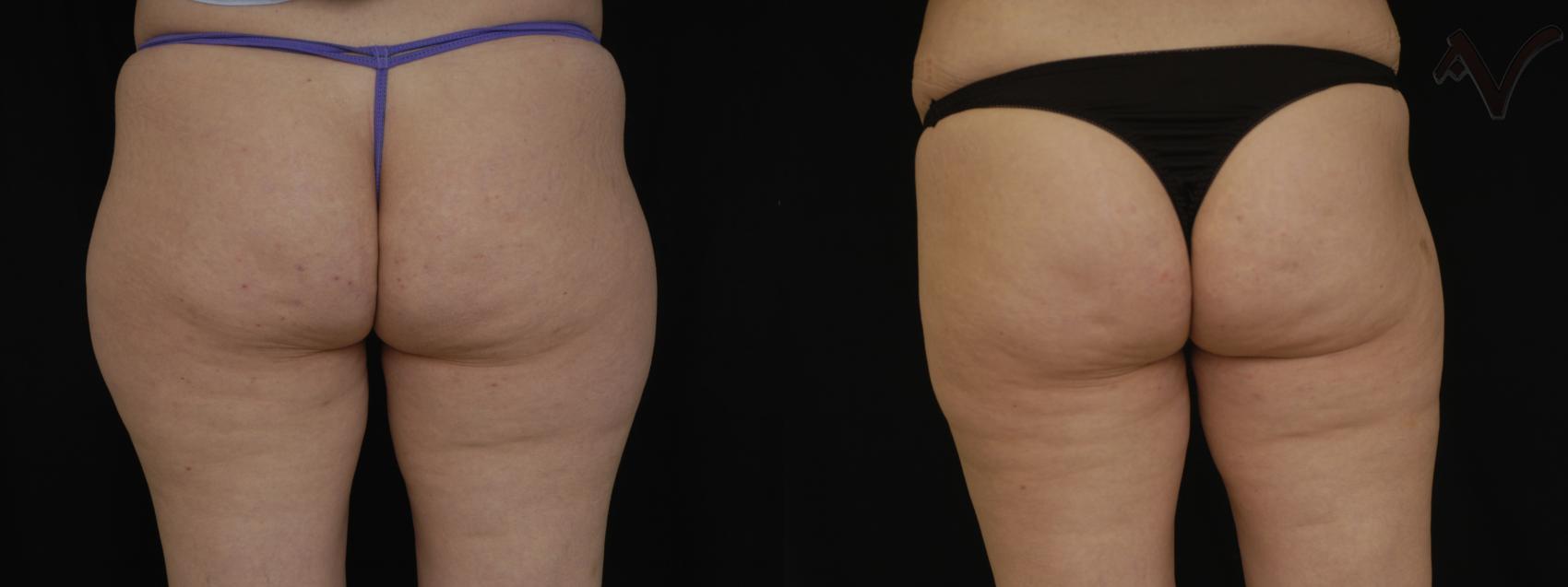 Before & After Liposuction Case 72 Back View of Thighs View in Burbank, CA