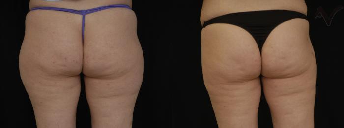 Before & After Liposuction Case 72 Back View of Thighs View in Los Angeles, CA
