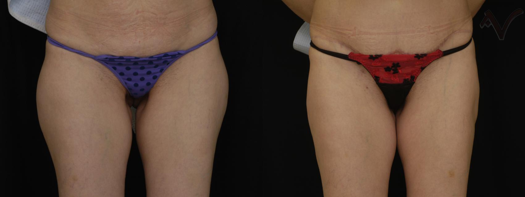 Before & After Liposuction Case 72 Front View of Thighs View in Los Angeles, CA