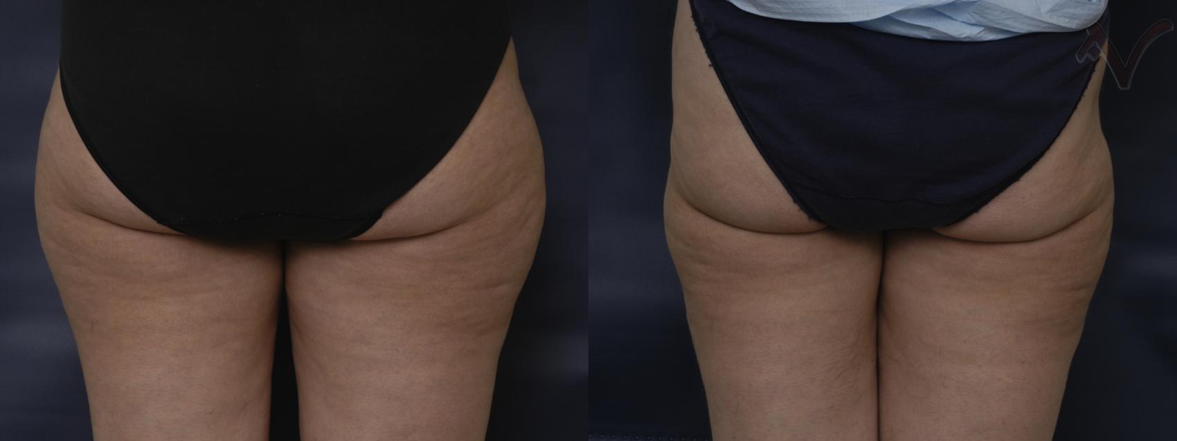 Before & After Liposuction Case 73 Back View of Thighs View in Burbank, CA