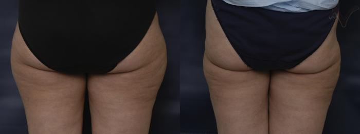 Before & After Liposuction Case 73 Back View of Thighs View in Los Angeles, CA
