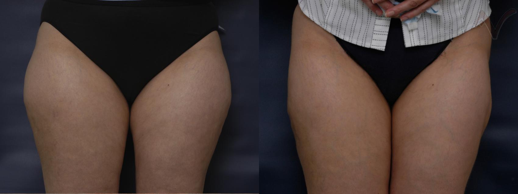 Before & After Liposuction Case 73 Front View of Thighs View in Los Angeles, CA
