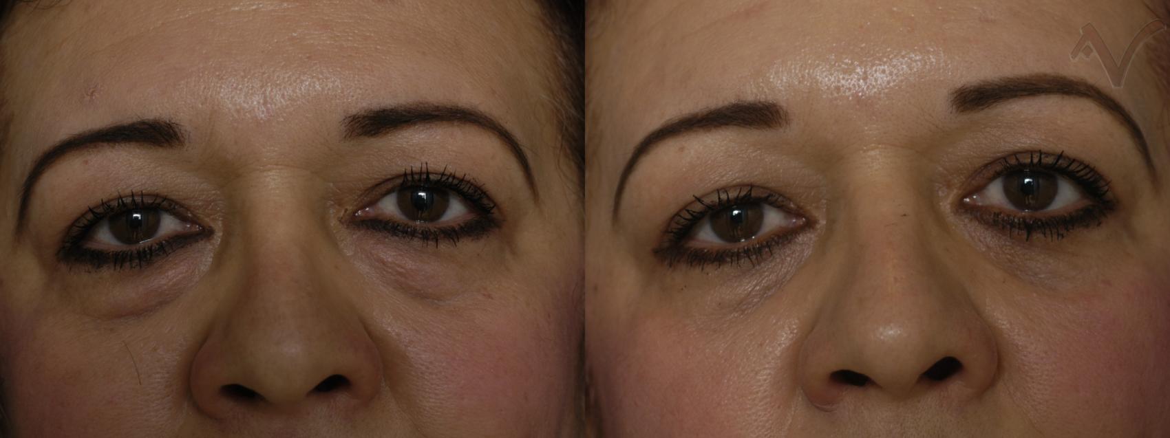 Before & After Lower Eyelid Surgery Case 285 Front View in Los Angeles, CA