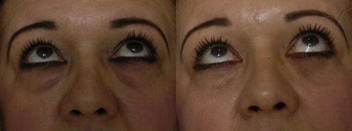 Before & After Lower Eyelid Surgery Case 285 Upward Look View in Los Angeles, CA