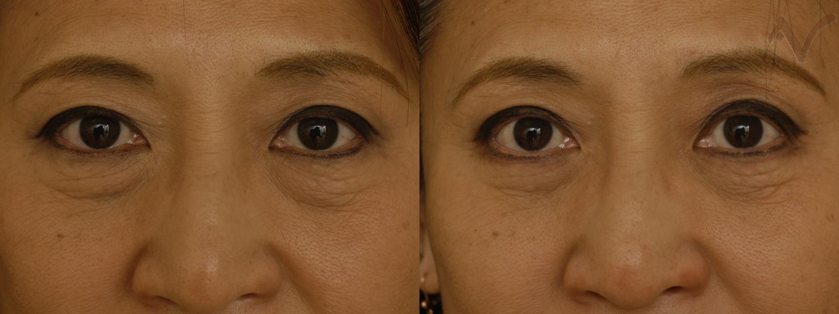 Before & After Lower Eyelid Surgery Case 287 Front View in Los Angeles, CA