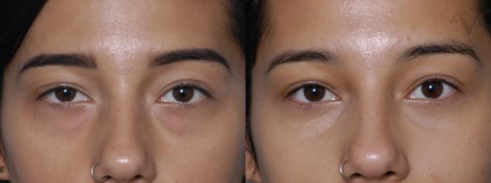 Before & After Lower Eyelid Surgery Case 289 Front View in Los Angeles, CA