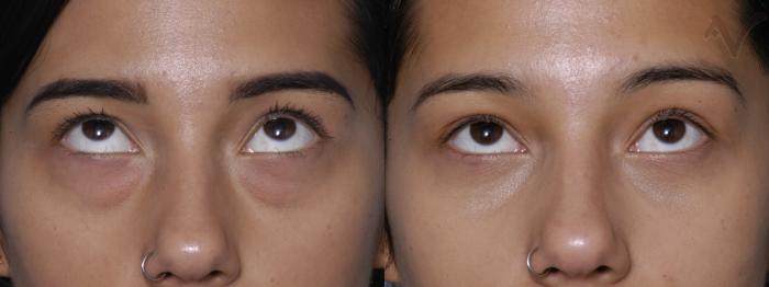 Before & After Lower Eyelid Surgery Case 289 Upward Look View in Los Angeles, CA