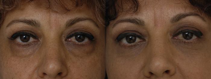 Before & After Lower Eyelid Surgery Case 298 Front View in Los Angeles, CA