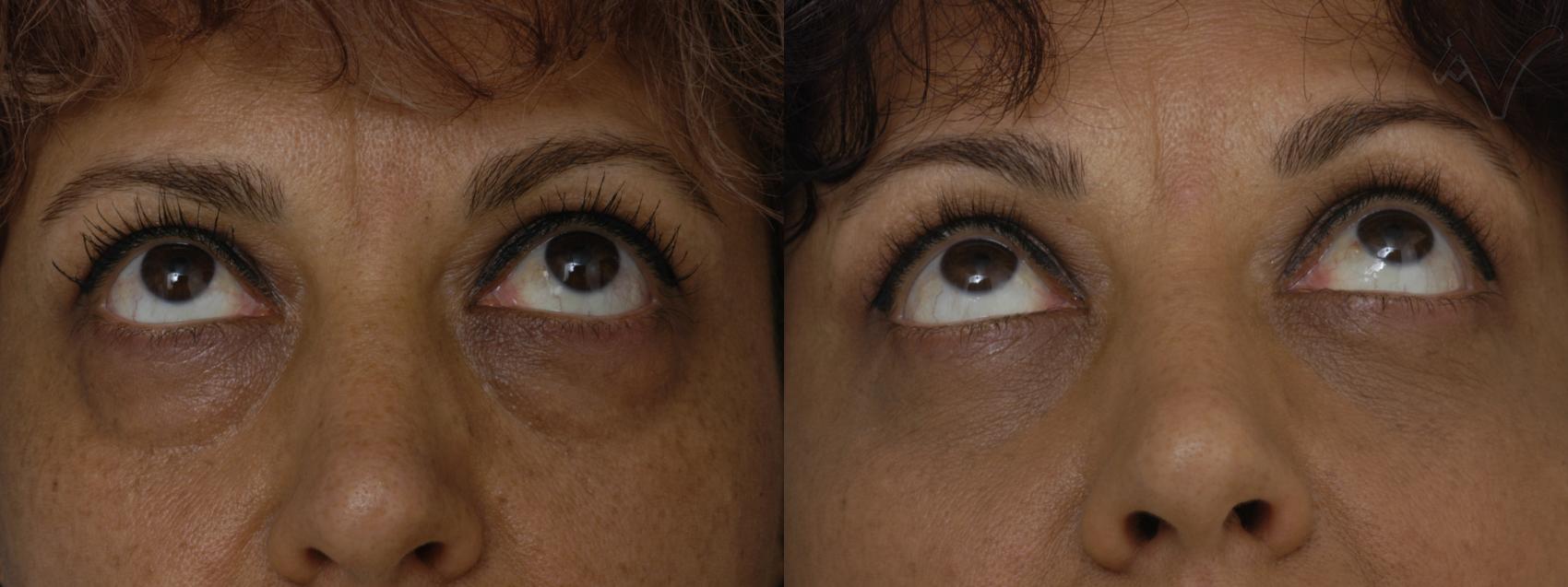 Before & After Lower Eyelid Surgery Case 298 Upward Look View in Los Angeles, CA