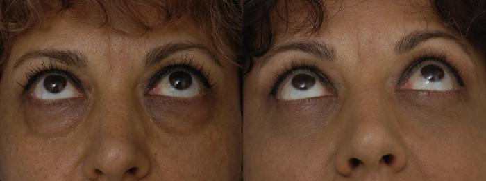 Before & After Lower Eyelid Surgery Case 298 Upward Look View in Los Angeles, CA