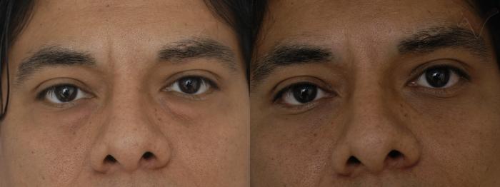 Before & After Lower Eyelid Surgery Case 302 Front View in Los Angeles, CA