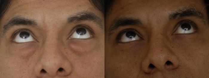 Before & After Lower Eyelid Surgery Case 302 Upward Look View in Los Angeles, CA